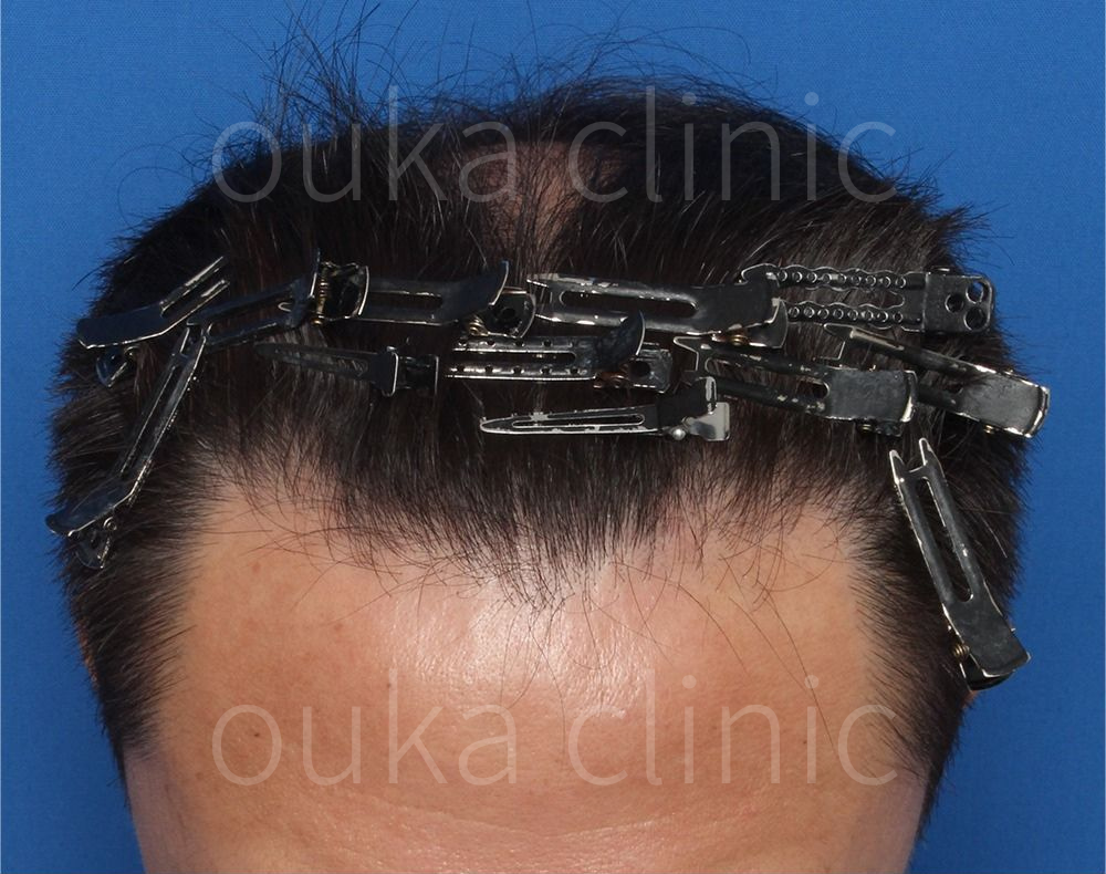 頭頂　生え際の治療前の画像